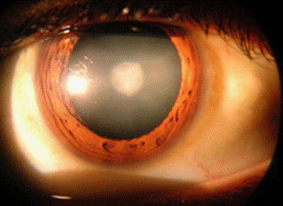 https://upload.wikimedia.org/wikipedia/commons/thumb/b/ba/Cataract_in_human_eye.png/220px-Cataract_in_human_eye.png