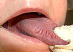 https://upload.wikimedia.org/wikipedia/commons/thumb/8/8a/Fissured_tongue.jpg/120px-Fissured_tongue.jpg