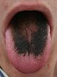 https://upload.wikimedia.org/wikipedia/commons/thumb/1/16/Black_tongue.jpg/90px-Black_tongue.jpg