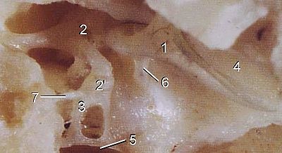 https://upload.wikimedia.org/wikipedia/commons/thumb/f/f4/Auditory_ossicles_%28bovine%29.jpg/400px-Auditory_ossicles_%28bovine%29.jpg