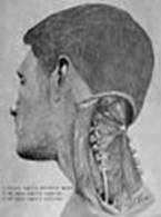 https://upload.wikimedia.org/wikipedia/commons/thumb/1/14/Suboccipital_triangle_dissection.jpg/89px-Suboccipital_triangle_dissection.jpg
