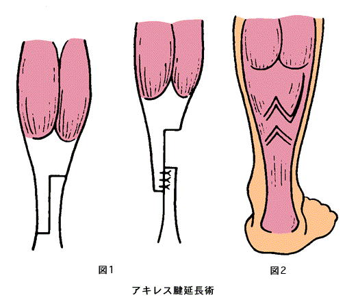 アキレス腱延長術